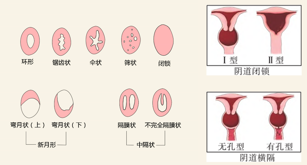 石女是什么情况图片